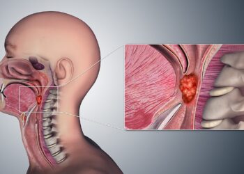 تعرف على سرطان الفم والحنجرة عوارضه وعلاجه