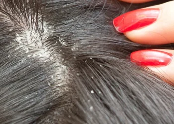 احذروا حيلة مضادة للقشرة على مواقع التواصل الاجتماعي ما هي ؟