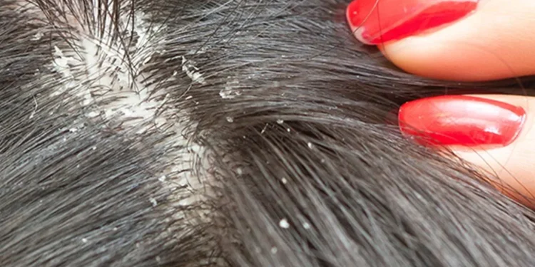 احذروا حيلة مضادة للقشرة على مواقع التواصل الاجتماعي ما هي ؟