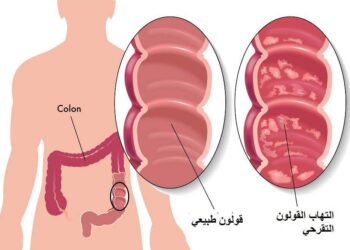 التهاب القلون التقرحي .. المعلومات الكاملة