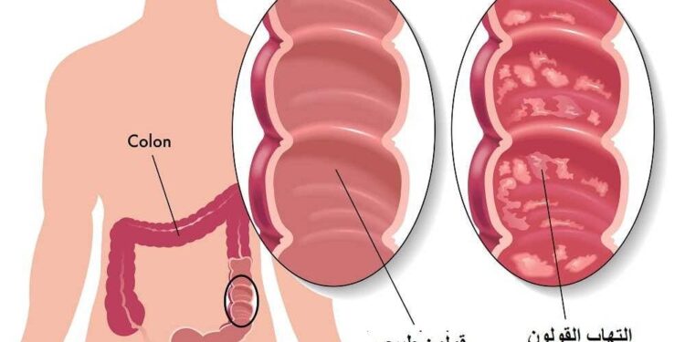 التهاب القلون التقرحي .. المعلومات الكاملة