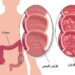 التهاب القلون التقرحي .. المعلومات الكاملة