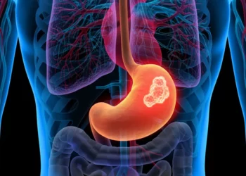 مشروبات نتناولها كلّنا تزيد خطر الإصابة بسرطان الأمعاء