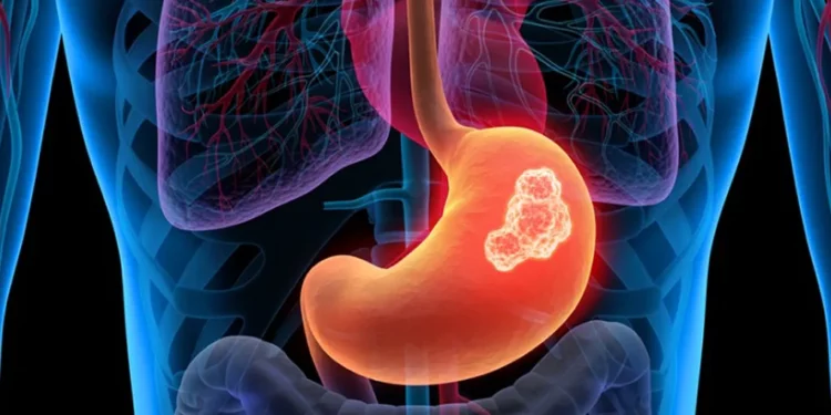 مشروبات نتناولها كلّنا تزيد خطر الإصابة بسرطان الأمعاء