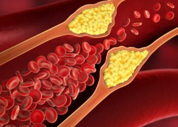 أعراض واضحة لارتفاع مستويات الكوليسترول في الدم
